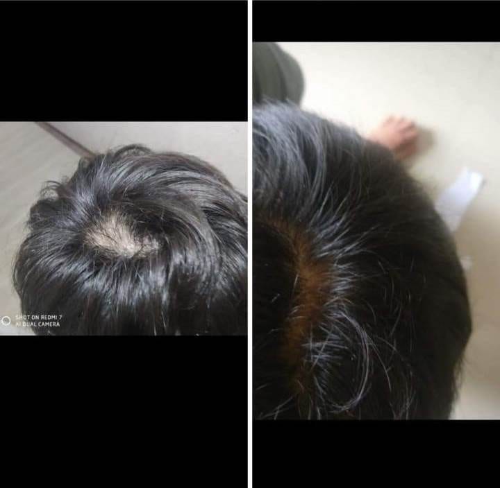 Hairfall Treatment by Dr poonam homeopathy homeopathic clinic In Balewadi Baner
