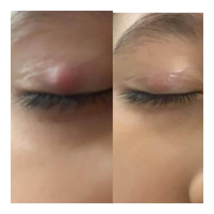 Homeopathy Treatment for skin infection by Dr poonam homeopathy homeopathic clinic In Balewadi Baner