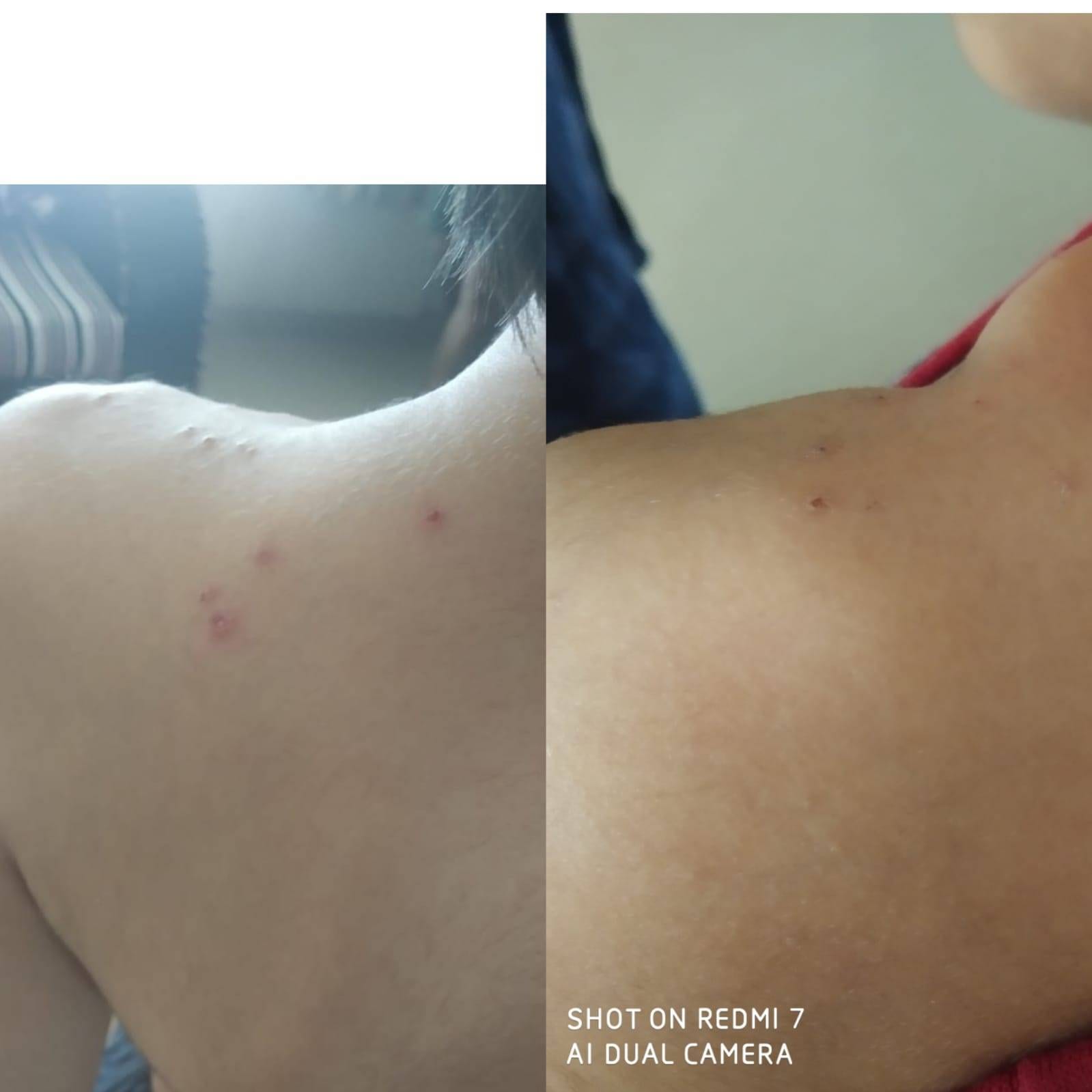 Homeopathy Treatment for skin infection by Dr poonam homeopathy homeopathic clinic In Balewadi Baner