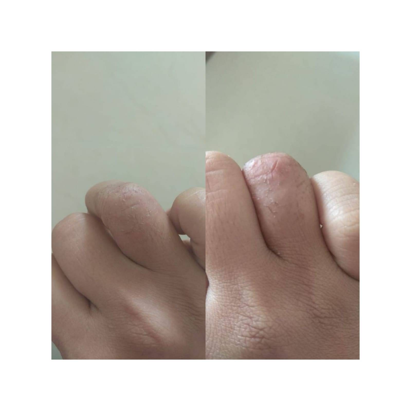 Homeopathy skin infection treatment by Dr poonam homeopathy homeopathic clinic In Balewadi Baner