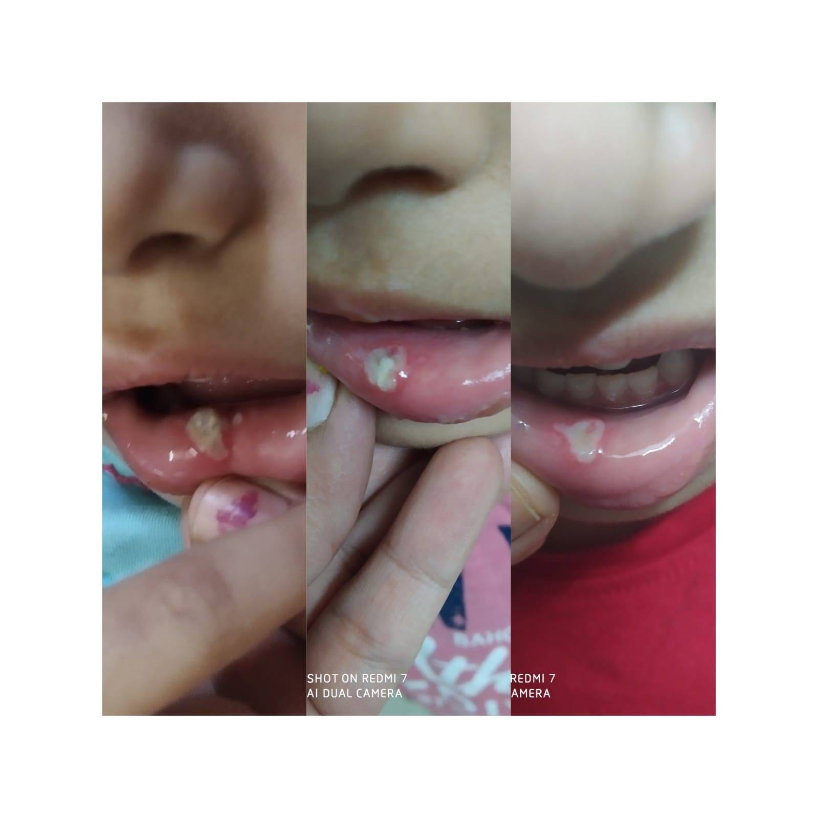 mouth blisters progress treatment by  Dr poonam homeopathy homeopathic clinic In Balewadi Baner