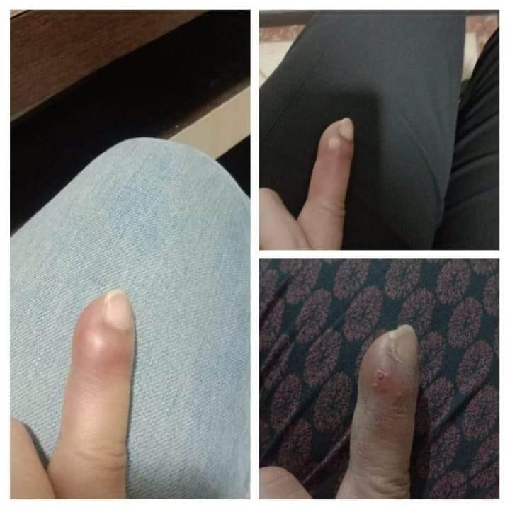 Homeopathy treatment for skin allregy by Dr poonam homeopathy homeopathic clinic In Balewadi Baner