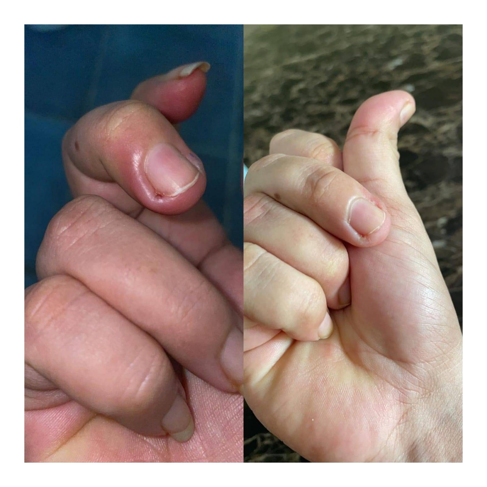 Skin infection Homeopathy treatment by Dr poonam homeopathy homeopathic clinic In Balewadi Baner