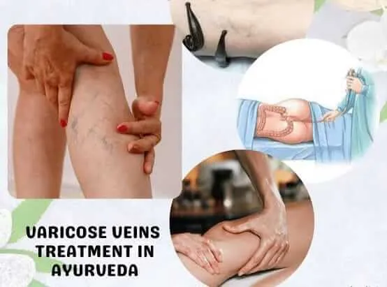Varicose Veins - Ayurvedic Panchakarma Clinic in Baner Balewadi